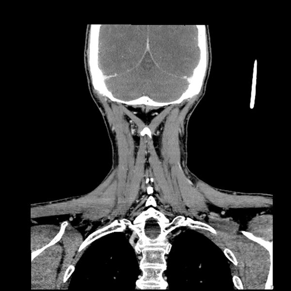 File:Anaplastic thyroid carcinoma (Radiopaedia 79087-92034 A 94).jpg