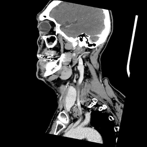 File:Anaplastic thyroid carcinoma (Radiopaedia 79087-92034 C 67).jpg