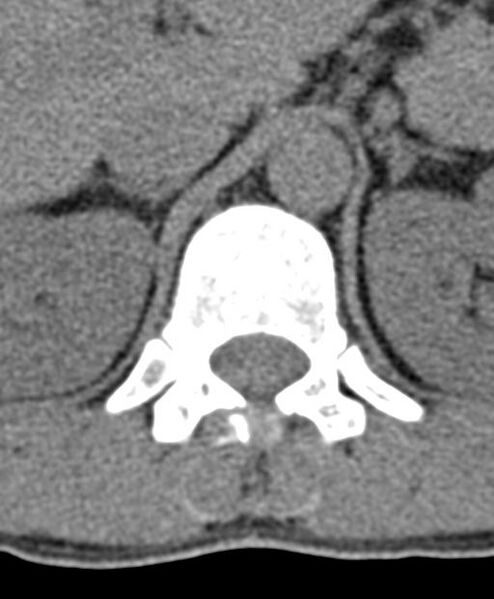 File:Aneurysmal bone cyst T11 (Radiopaedia 29294-29721 Axial non-contrast 52).jpg