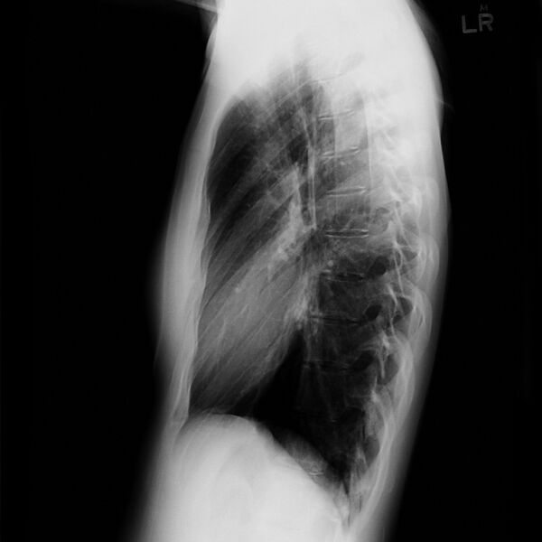 File:Angioinvasive aspergillosis (Radiopaedia 8651-15072 Lateral 1).jpg