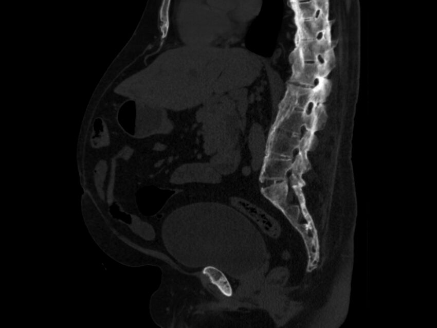 Ankylosing spondylitis (Radiopaedia 44609-48357 Sagittal bone window 50).jpg
