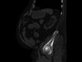 Ankylosing spondylitis (Radiopaedia 44609-48357 Sagittal bone window 82).jpg