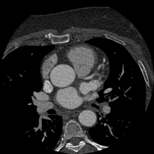 File:Anomalous origin of left circumflex artery from right coronary sinus (Radiopaedia 72563-83117 B 33).jpg
