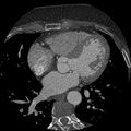 Anomalous origin of left circumflex artery from right coronary sinus (Radiopaedia 72563-83117 B 77).jpg