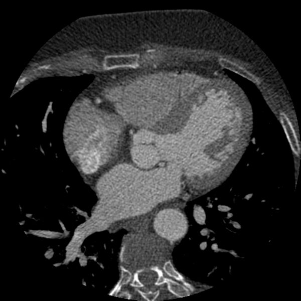 File:Anomalous origin of left circumflex artery from right coronary sinus (Radiopaedia 72563-83117 B 77).jpg
