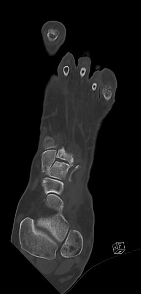 File:Anterior calcaneal process fracture (Radiopaedia 63353-71943 Coronal bone window 16).jpg