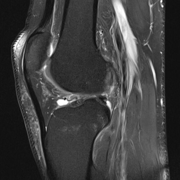File:Anterior cruciate ligament tear - ramp lesion (Radiopaedia 71883-82322 Sagittal PD fat sat 11).jpg