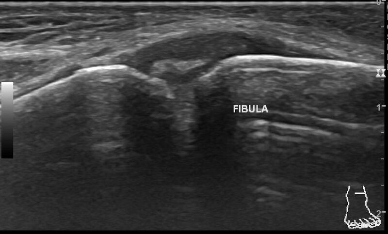 File:Anterior inferior tibiofibular ligament injury (Radiopaedia 65077-74073 Longitudinal 4).jpg