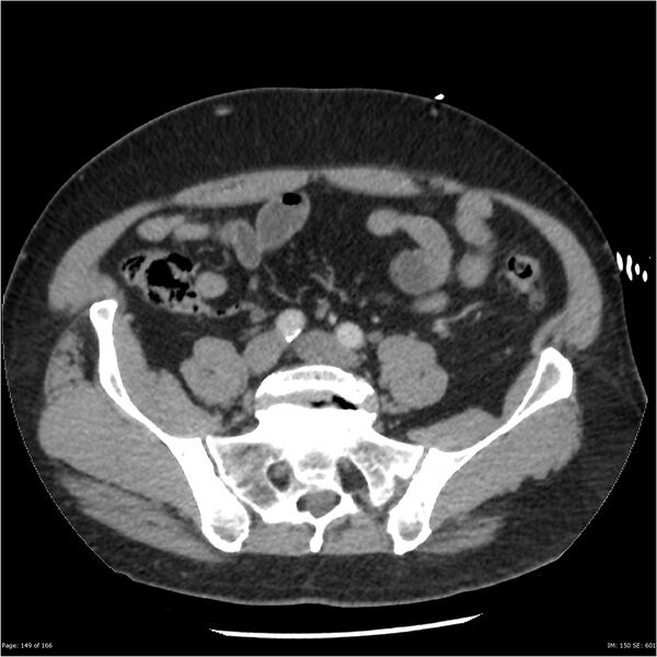 File:Aortic dissection- Stanford A (Radiopaedia 37759-39664 A 140).jpg