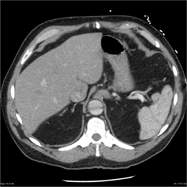 File:Aortic dissection- Stanford A (Radiopaedia 37759-39664 A 67).jpg