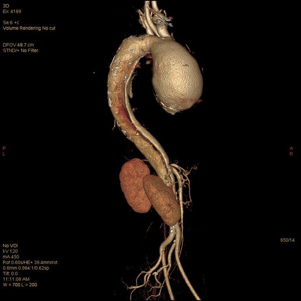 File:Aortic dissection (Radiopaedia 25350-25604 E 14).jpg