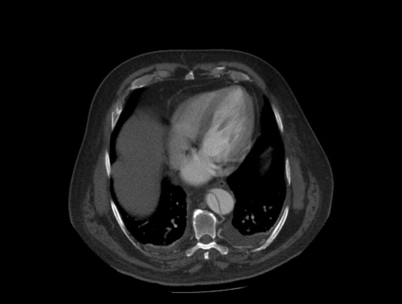 File:Aortic dissection (Radiopaedia 28802-29105 A 30).jpg