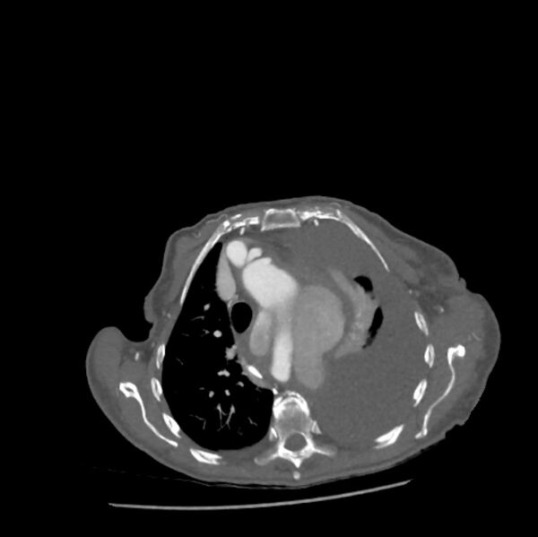 File:Aortic dissection (Radiopaedia 68763-78691 A 12).jpeg