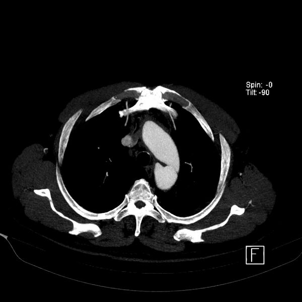 File:Aortic dissection - De Bakey type III - Stanford B (Radiopaedia 21903-21882 B 15).jpg