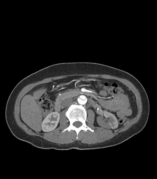 File:Aortic dissection with renal ischemia (Radiopaedia 76573-88338 A 72).jpg