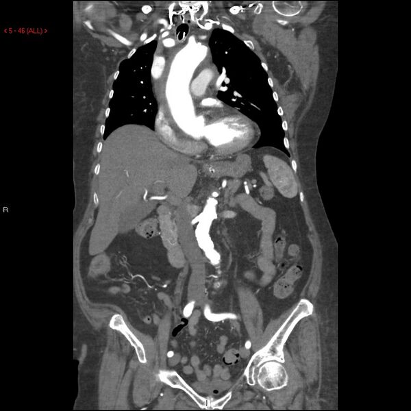File:Aortic intramural hematoma (Radiopaedia 27746-28001 B 23).jpg