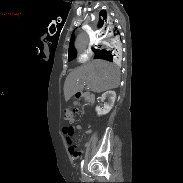 File:Aortic intramural hematoma (Radiopaedia 27746-28001 C 11).jpg