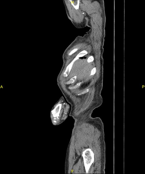File:Aortoenteric fistula (Radiopaedia 84308-99603 C 22).jpg