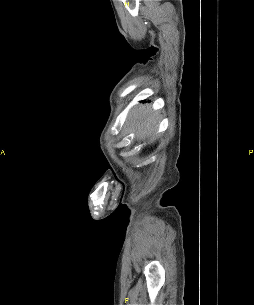 Aortoenteric fistula (Radiopaedia 84308-99603 C 22).jpg
