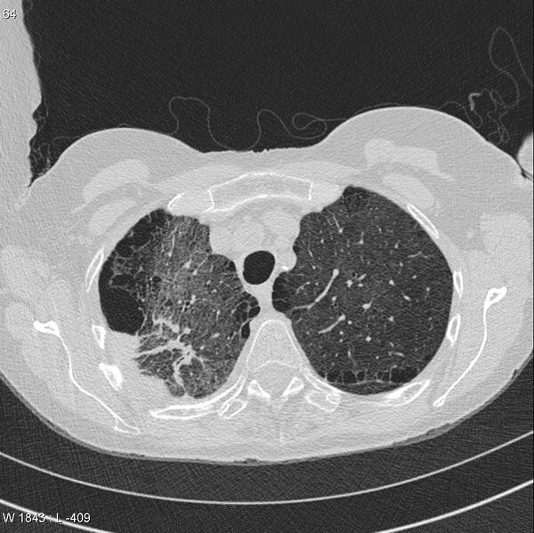 File:Apical non-small-cell lung cancer (Radiopaedia 8570-9405 Axial lung window 9).jpg