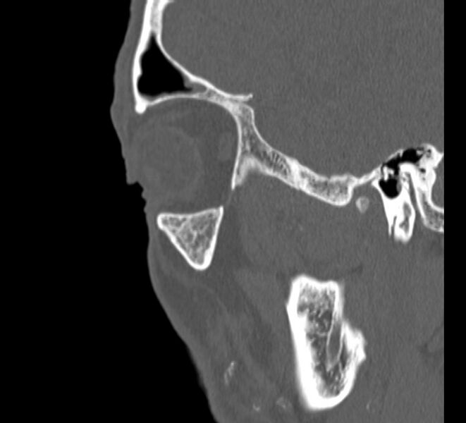 File:Aplastic maxillary sinuses (Radiopaedia 60030-67561 Sagittal bone window 28).jpg