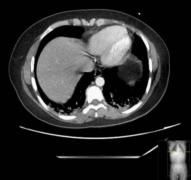 File:Appendicitis (CT angiogram) (Radiopaedia 154713-127660 Axial 177).jpg