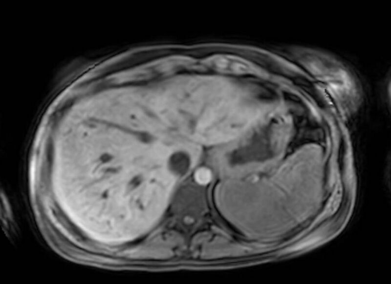 File:Appendicitis in gravida (MRI) (Radiopaedia 89433-106395 Axial DIXON 13).jpg