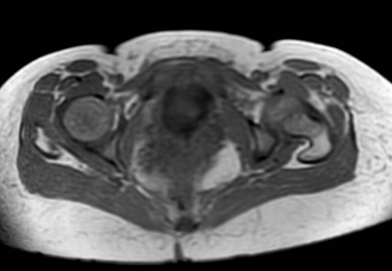 File:Appendicitis in gravida (MRI) (Radiopaedia 89433-106395 Axial T1 in-phase 68).jpg