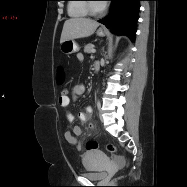 File:Appendicitis with microperforation- promontoric type (Radiopaedia 27268-27442 A 28).jpg
