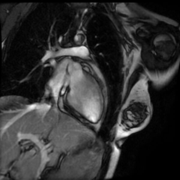 File:Arrhythmogenic right ventricular cardiomyopathy (Radiopaedia 87505-103850 2ch (LV) Cine SSFP 12).jpg
