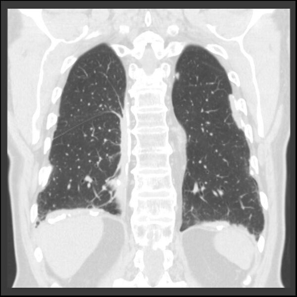 File:Asbestos-related pleural plaques (Radiopaedia 39069-41255 Coronal lung window 20).jpg