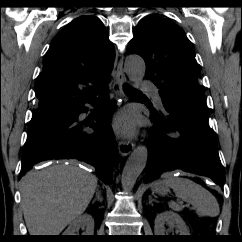 Asbestos-related pleural plaques (Radiopaedia 39069-41255 Coronal non-contrast 34).jpg
