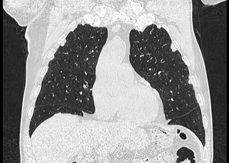 File:Asbestos pleural placques (Radiopaedia 57905-64872 Coronal lung window 93).jpg