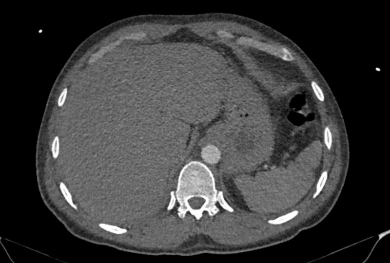 File:Ascending aortic aneurysm (Radiopaedia 86279-102297 C 62).jpg