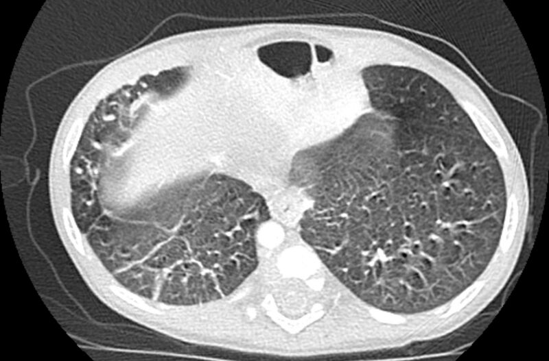 File:Asplenia syndrome (Radiopaedia 73083-83792 Axial lung window 60).jpg