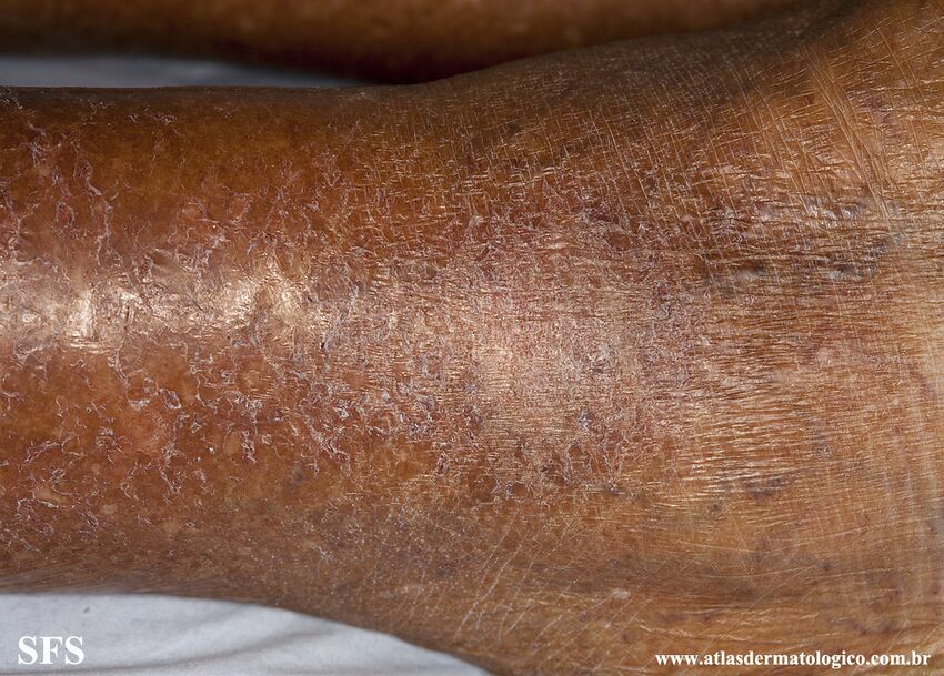Asteatotic Dermatitis (Dermatology Atlas 7).jpg