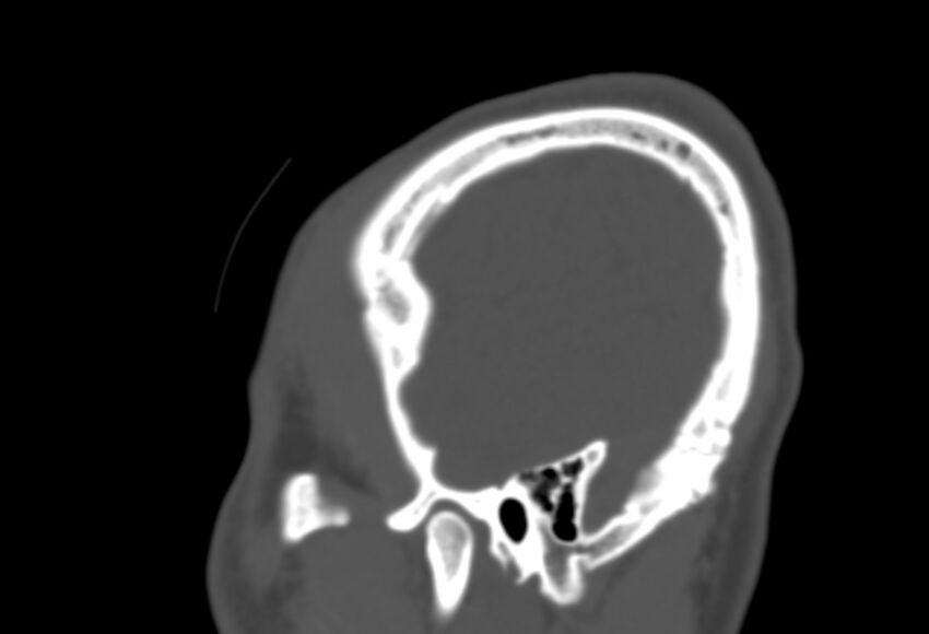 Asymptomatic occipital spur (Radiopaedia 87753-104201 Sagittal bone window 281).jpg