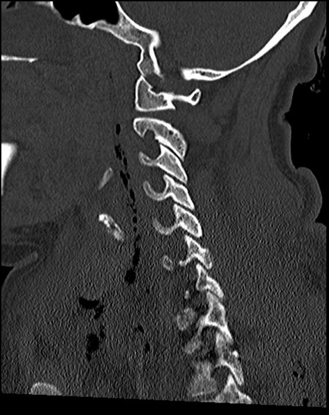 File:Atlanto-occipital dissociation - Traynelis type 1 (Radiopaedia 87570-103948 Sagittal bone window 38).jpg