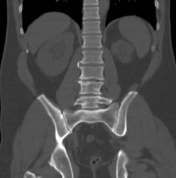 File:Atrophic kidney due to severe chronic obstructive hydronephrosis (Radiopaedia 40828-43474 Coronal bone window 8).jpg