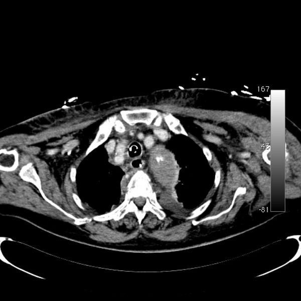 File:Atypical dissection of the thoracic aorta (Radiopaedia 10975-78320 A 4).jpg