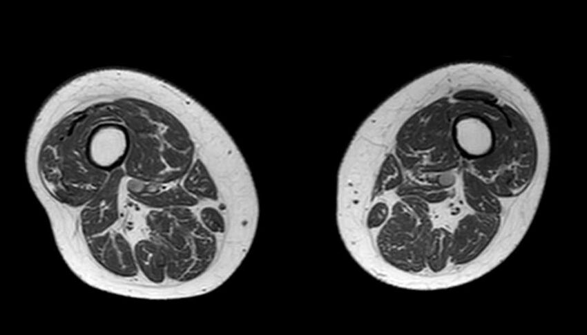 Atypical lipomatous tumor - thigh (Radiopaedia 68975-78734 Axial T1 35).jpg