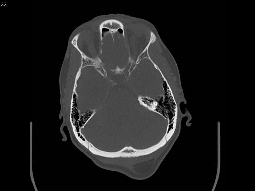 Atypical meningioma - intraosseous (Radiopaedia 64915-73867 Axial C+ bone window 22).jpg