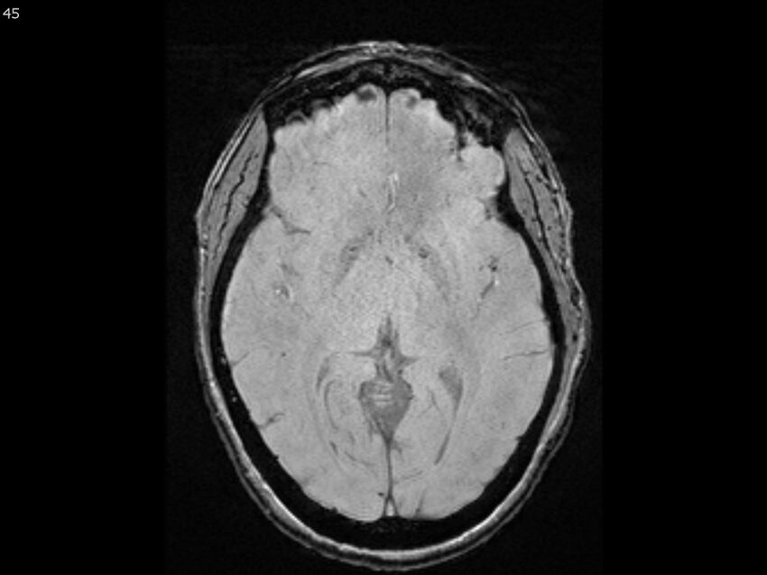 Atypical meningioma - intraosseous (Radiopaedia 64915-74572 Axial SWI 45).jpg