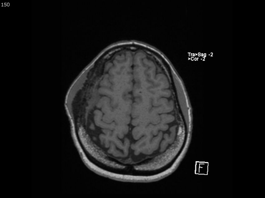 Atypical meningioma - intraosseous (Radiopaedia 64915-74572 Axial T1 150).jpg