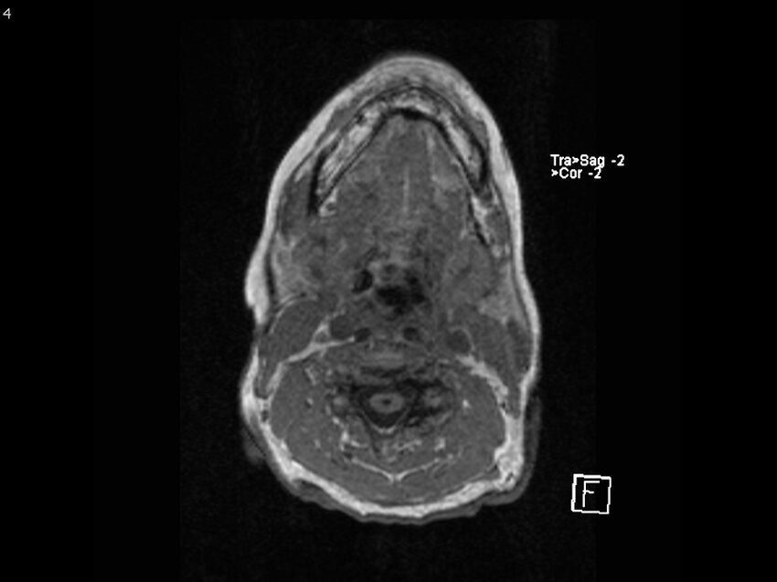 Atypical meningioma - intraosseous (Radiopaedia 64915-74572 Axial T1 4).jpg