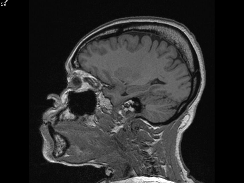 Atypical meningioma - intraosseous (Radiopaedia 64915-74572 Sagittal T1 59).jpg