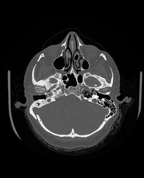 File:Automastoidectomy with labyrinthine fistula (Radiopaedia 84143-99411 Axial non-contrast 79).jpg