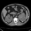 Autosomal dominant polycystic kidney disease (Radiopaedia 36539-38101 Axial non-contrast 34).jpg
