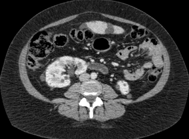 File:Autosomal dominant polycystic kidney disease (Radiopaedia 57124-64017 A 64).jpg