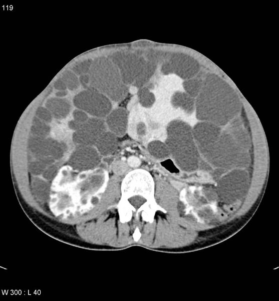 File:Autosomal dominant polycystic kidney disease with extensive hepatic involvement (Radiopaedia 5204-6971 B 16).jpg